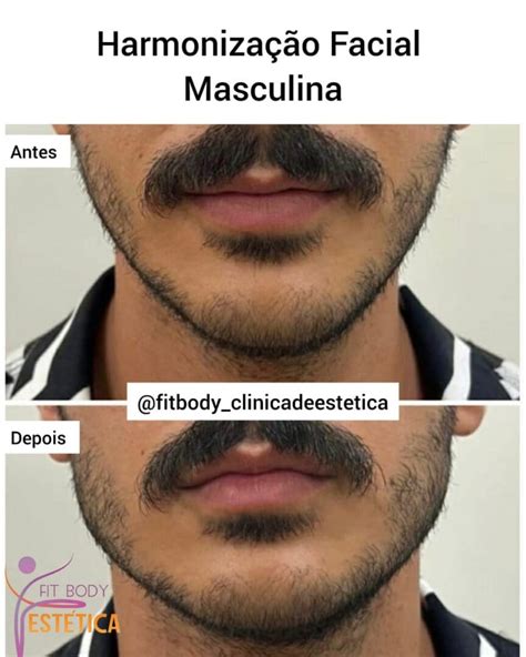 Harmoniza O Facial Para Homens Antes E Depois