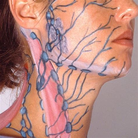 Patient Guide To Head And Neck Lymphedema Artofit