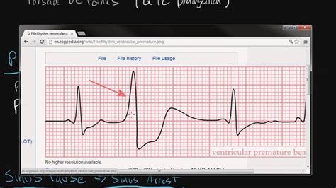 Electrocardiography Cardiac Arrhythmias Youtube