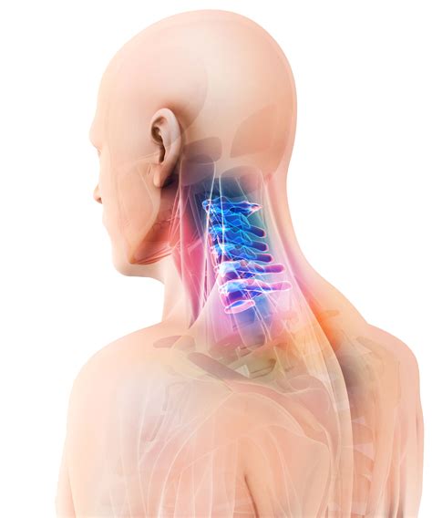 Chronic Neck Pain Cell Bionics Spine Pro