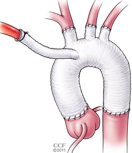 Basics Of Cardiopulmonary Bypass Normal And Abnormal Postoperative Ct Appearances Radiographics