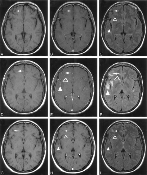 Calcified Neurocysticercosis Lesions Trigger Symptomatic Inflammation