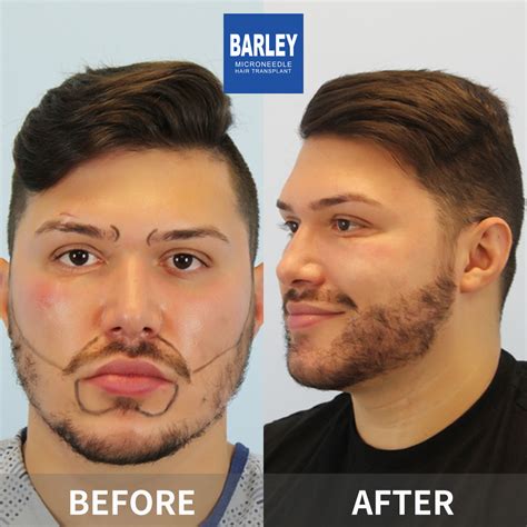 Beard Transplant Results: Transform Your Look with Natural and ...