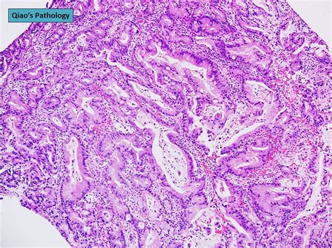 Flickriver Photoset Adenocarcinoma Of The Urinary Bladder By Qiaos