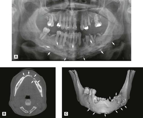 Osteomyelitis Jaw Radiographic Appearance