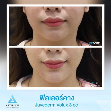 รีวิว Attitude Clinic ห้วยขวาง รีวิวฉีดฟิลเลอร์คาง Juvedrem Volux 3