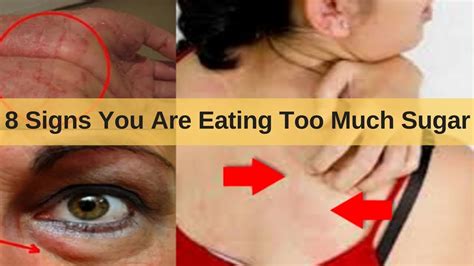 Signs You Are Eating Too Much Sugar You Don T Know Youtube