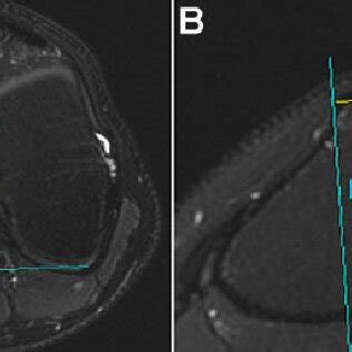 Method For Determining Tibial Tubercle Trochlear Groove Tt Tg