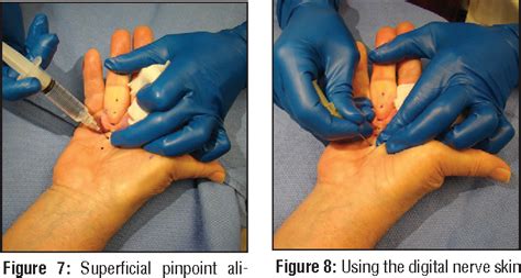 Figure 8 From Ultrasound Assisted Percutaneous Needle Fasciotomy For