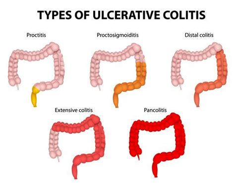 Treat Ulcerative Colitis Manhattan Laparoscopic Surgery