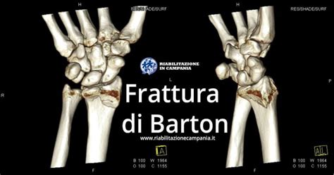 Frattura Di Barton Trattamento E Riabilitazione Riabilitazione In