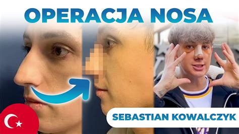 Operacja Nosa W Turcji TikToker Sebastian Kowalczyk Reakcja Na Nowy