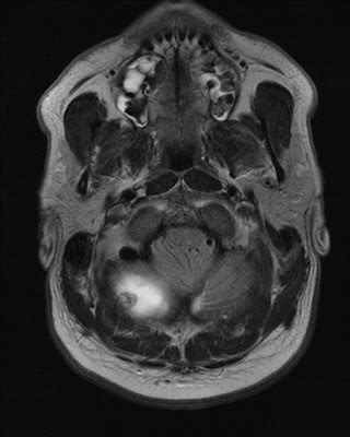 MRI LINKS AND OTHER COOL THINGS: Astrocytoma & MRI