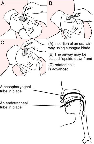 Airway | definition of airway by Medical dictionary in 2024 | Advanced