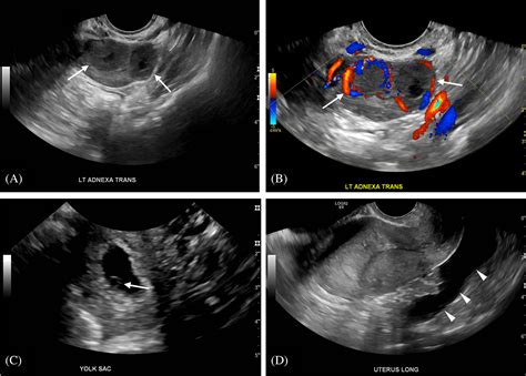 Corpus Luteum Ultrasound