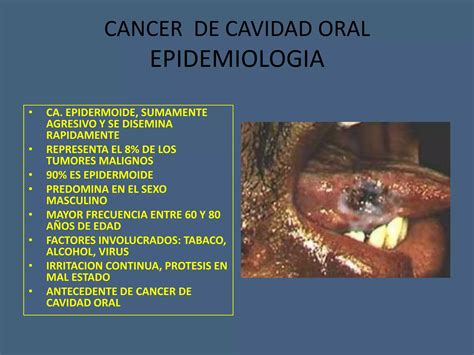 Tumores Benignos Y Malignos De Cavidad Oral Ppt