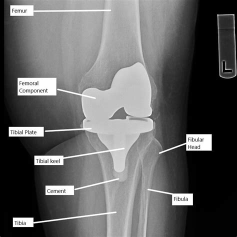 Stiffness after Knee Replacement Surgery - Complete Orthopedics