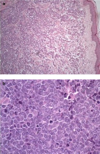 Tdt Expression In Merkel Cell Carcinoma Potential Diagnostic Pitfall