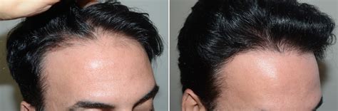 Hair Transplants For Men Photos Miami Fl Patient125275