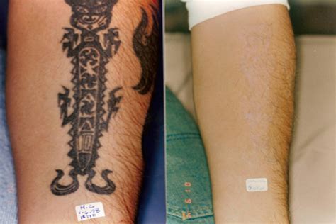 OUTattoo Eliminar Tatuajes Con Laser Cicatrices Y Manchas