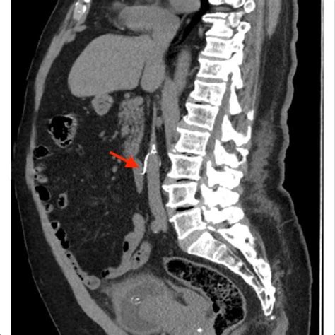 CT abdomen and pelvis coronal view demonstrating one of the IVC filter ...