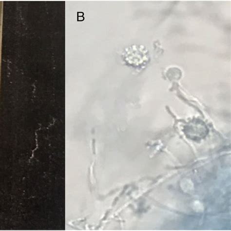 Histoplasma Capsulatum Culture On Sda At C After Days A And