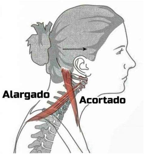 Fisioterapia Para La Cervicalgia O Dolor Cervical Avanfi