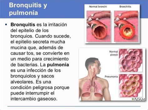 Diferencias Entre Bronquitis Y Pulmonía Cuadros Comparativos Cuadro