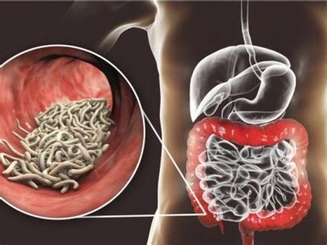 sintomas de los parasitos intestinales senales   podes ignorar