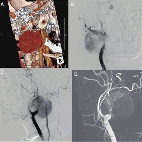 Cta And Diagnostic Angiogram A Neck Contrast Enhanced Ct Scan