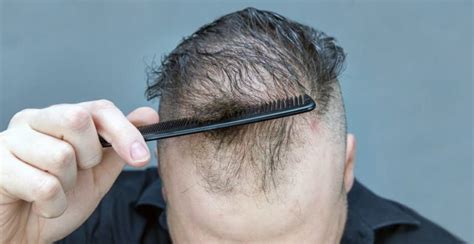 Wie Lassen Sich Kopfhauterkrankungen Mit Haarausfall Heilen