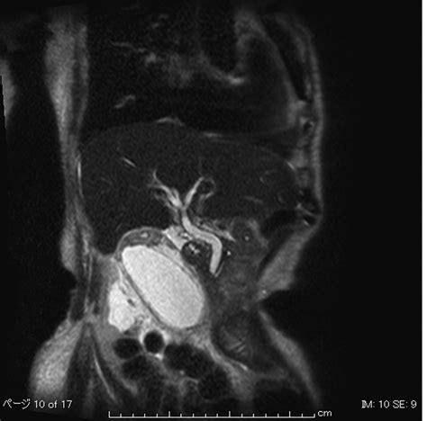 Complete Acute Gallbladder Torsion Diagnosed With Abdominal Ultrasonography And Colour Doppler