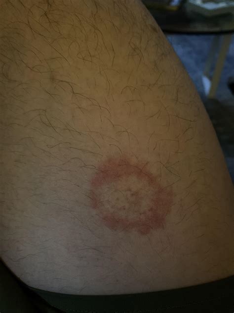 Ring Worm Lyme Disease Or Just A Circular Rash Dont Know How It Appeared Rdermatology