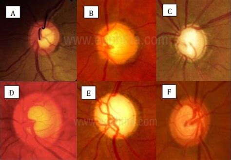 Evaluation of The Optic Nerve Head in Glaucoma