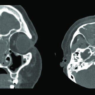 Computed Tomography Ct Of Maxillary Sinus Hemangioma Mass Of