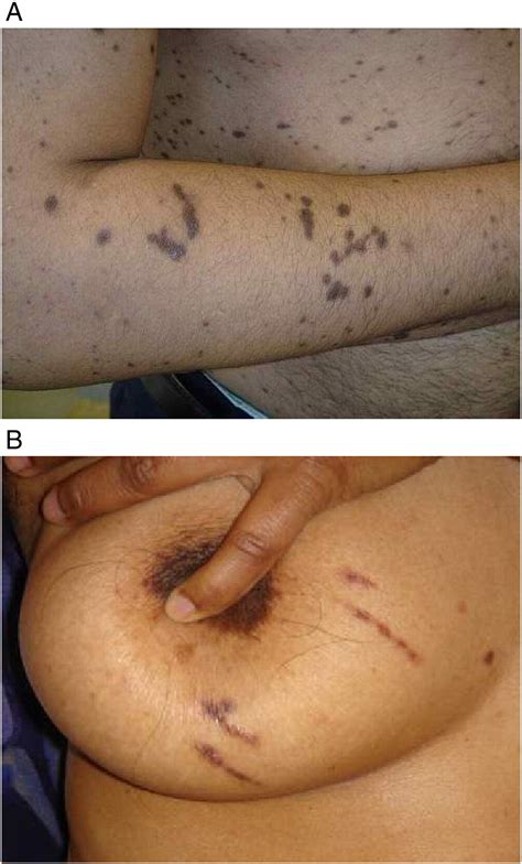 The Koebner Phenomenon Clinics In Dermatology