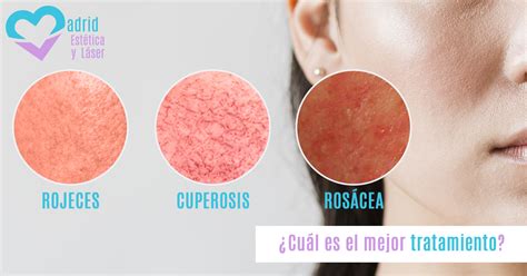 Tratamiento Láser Cuperosis Y Rosácea Estética Y Laser Madrid