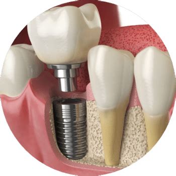 Veja como conseguir Implante Dentário Pelo SUS Seu site de notícias e