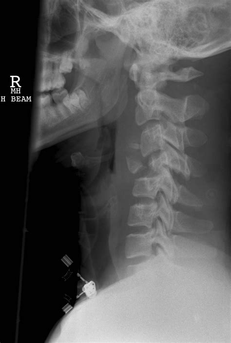 Flexion Teardrop Fracture