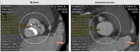 Ecmo Tavr Pci