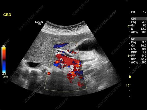 Cholelithiasis Ultrasound