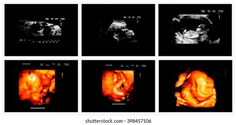 Collection Set Ultrasound Image Baby Womb Stock Photo 398457106 ...