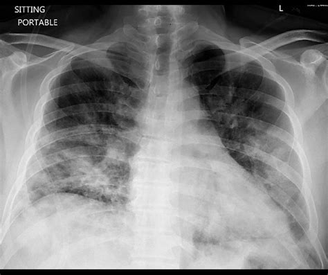 American Journal Of Case Reports A Case Of Spontaneous Pneumothorax