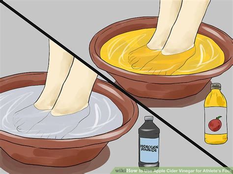 4 Ways to Use Apple Cider Vinegar for Athlete's Foot - wikiHow