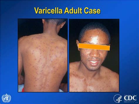 Ppt Evaluating Patients With Acute Generalized Vesicular Or Pustular Rash Illnesses Powerpoint