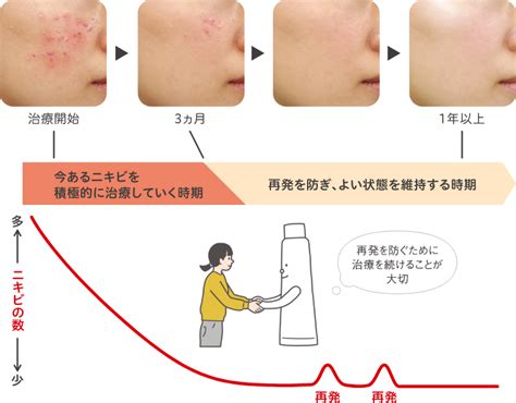 コメドを知ろう！｜ニキビ一緒に治そうproject｜製薬会社のマルホ