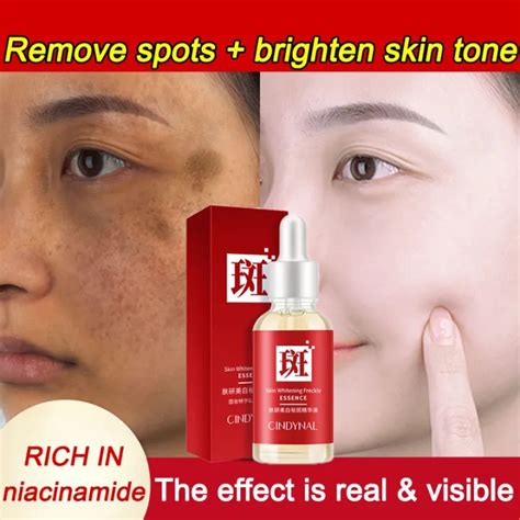 Effective Whitening Freckle Serum Removal Melasma Pekas Removal Serum