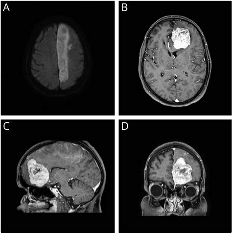 Figure 1 From Frontal Parafalcine Meningioma Presenting As Anterior