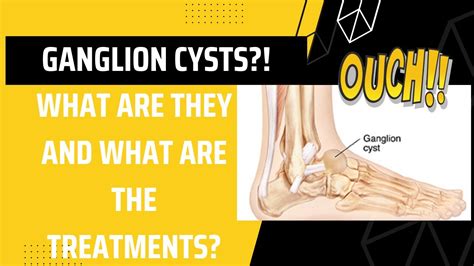 Ganglion Cysts Mucoid Cysts Oh My Youtube