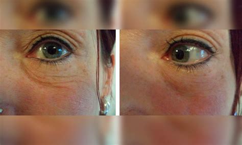 Ultraformer Para Rejuvenescimento Da Rea Dos Olhos Off